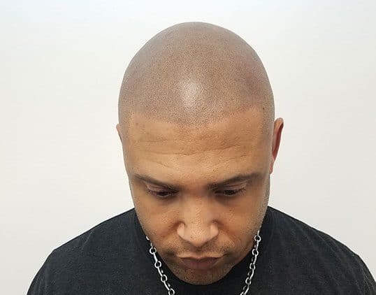 Navigating Scalp Micropigmentation Regrets: Expert Advice